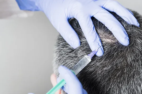 Mesoterapia dei Capelli